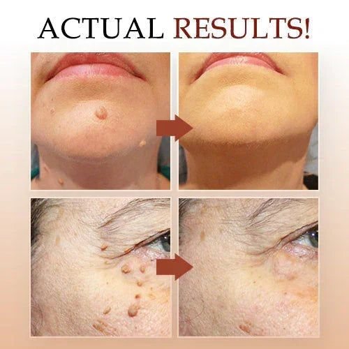 Jaysuing Liquid Wart Remover – Advanced Wart Removal Treatment for Face, Hands & Body – alternate view