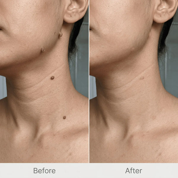 Derma Smooth Spot Corrector – Skin Tag & Mole Remover Patch - alternate view